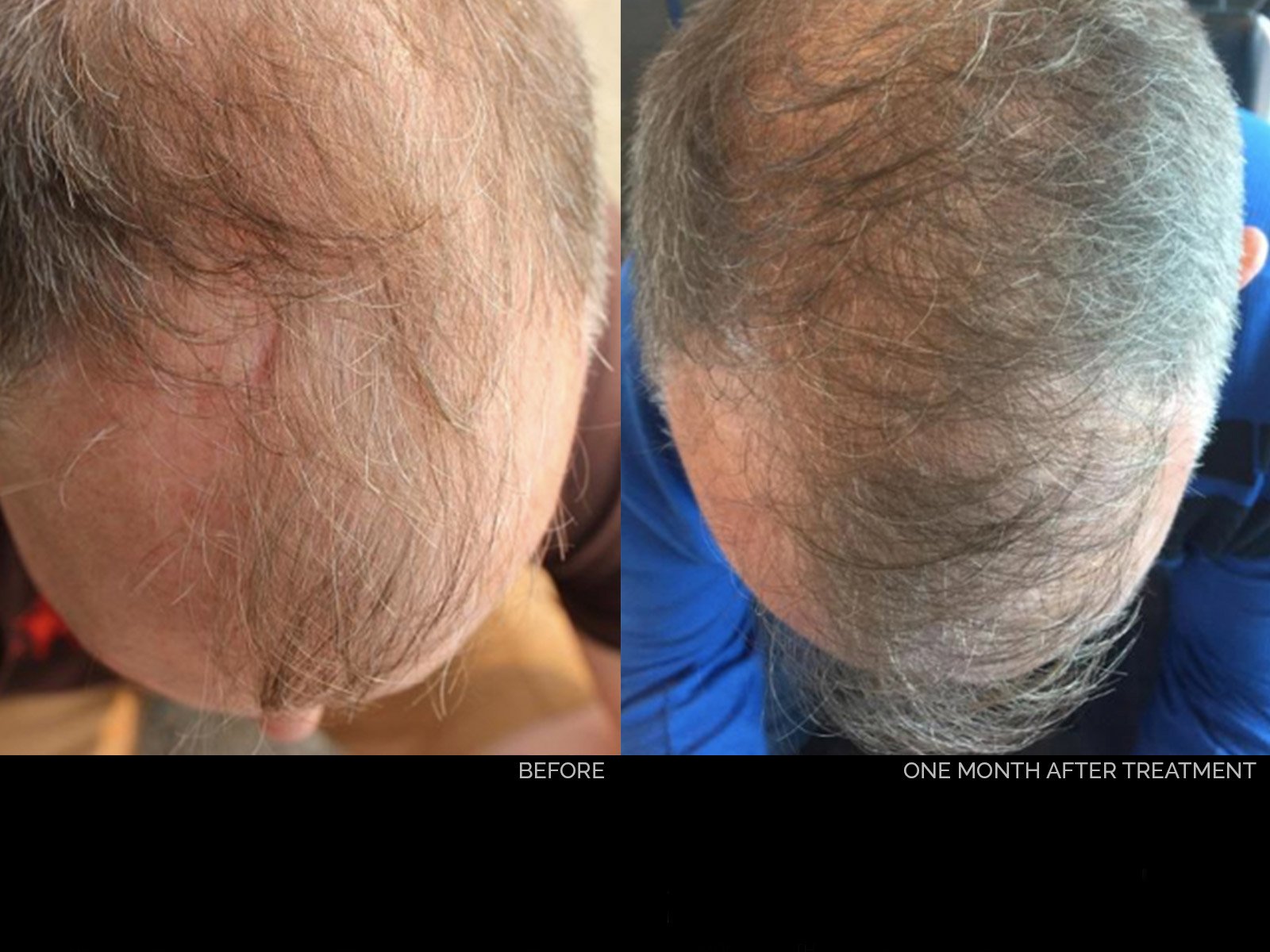 hair-rejuvenation-before-after-3