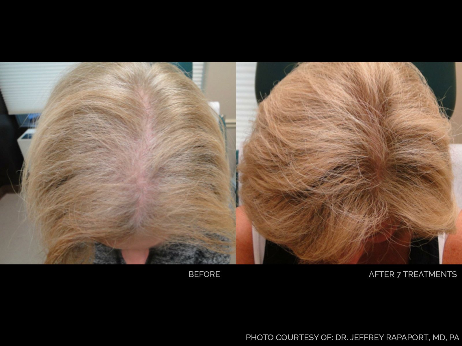 hair-rejuvenation-before-after-4