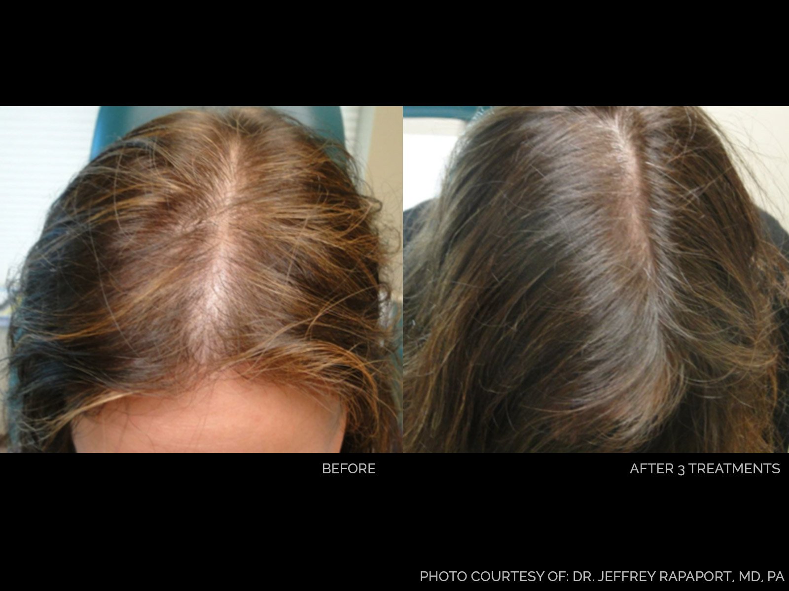 hair-rejuvenation-before-after-5