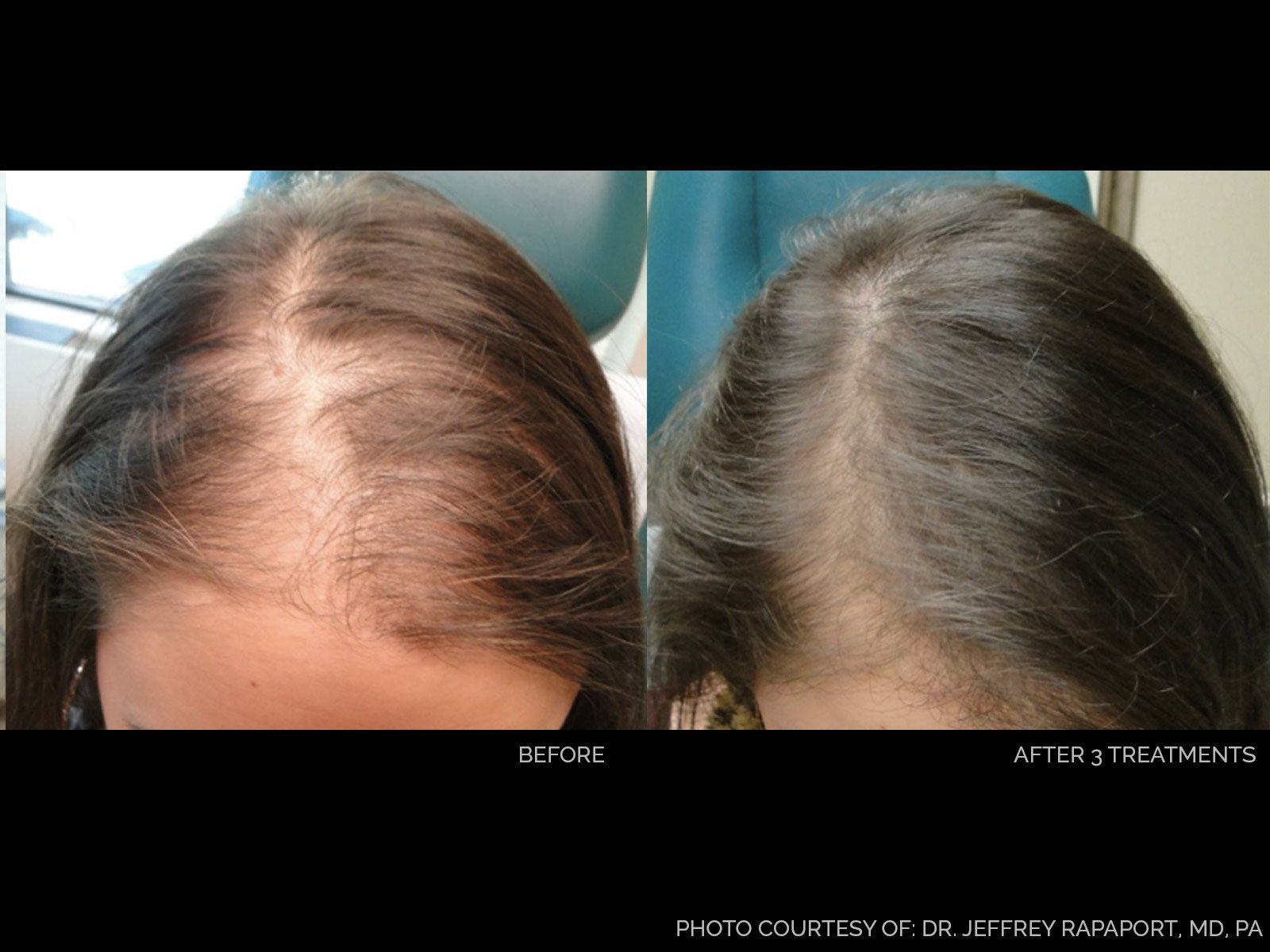 hair-rejuvenation-before-after-6