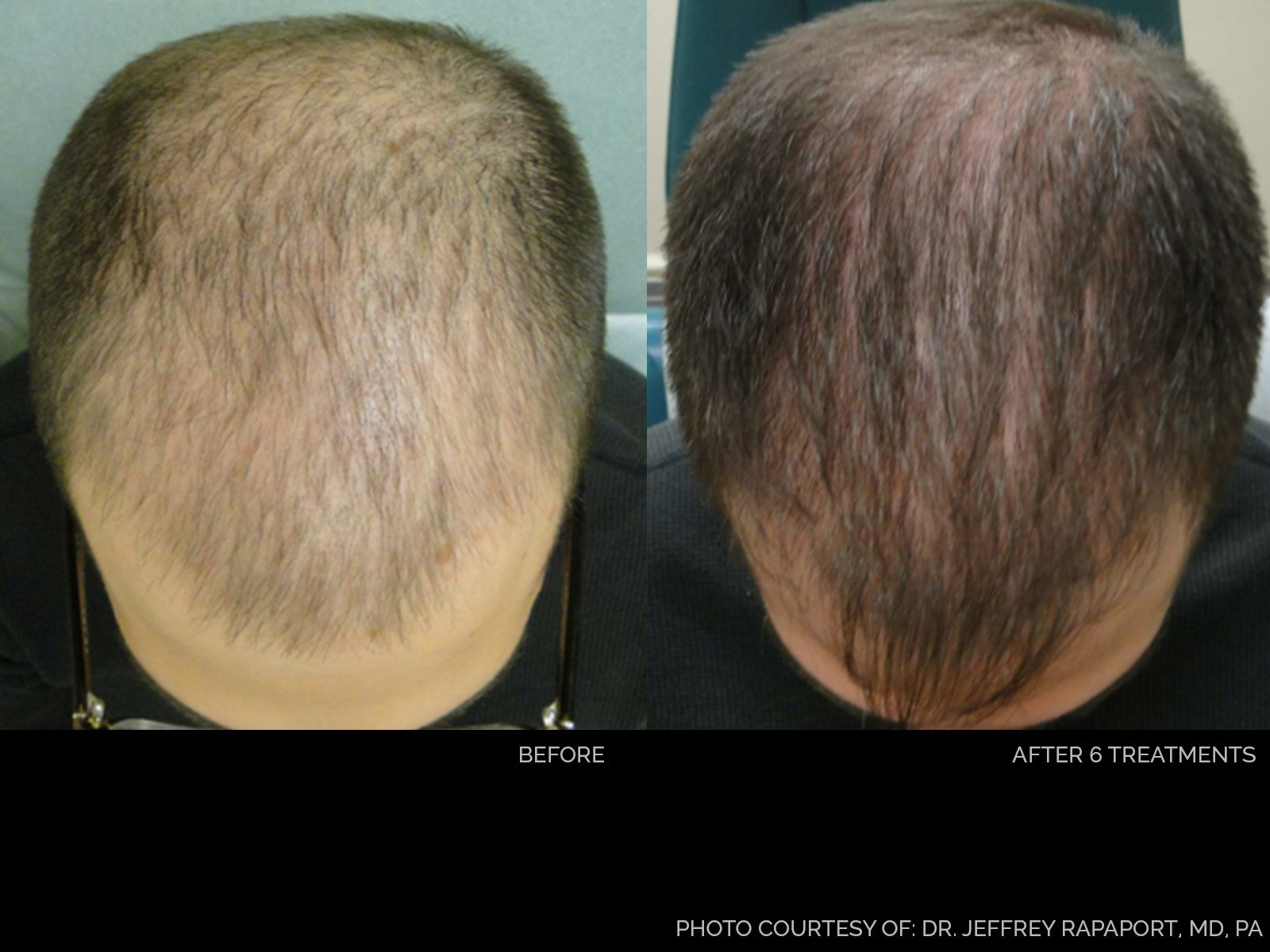 hair-rejuvenation-before-after-7