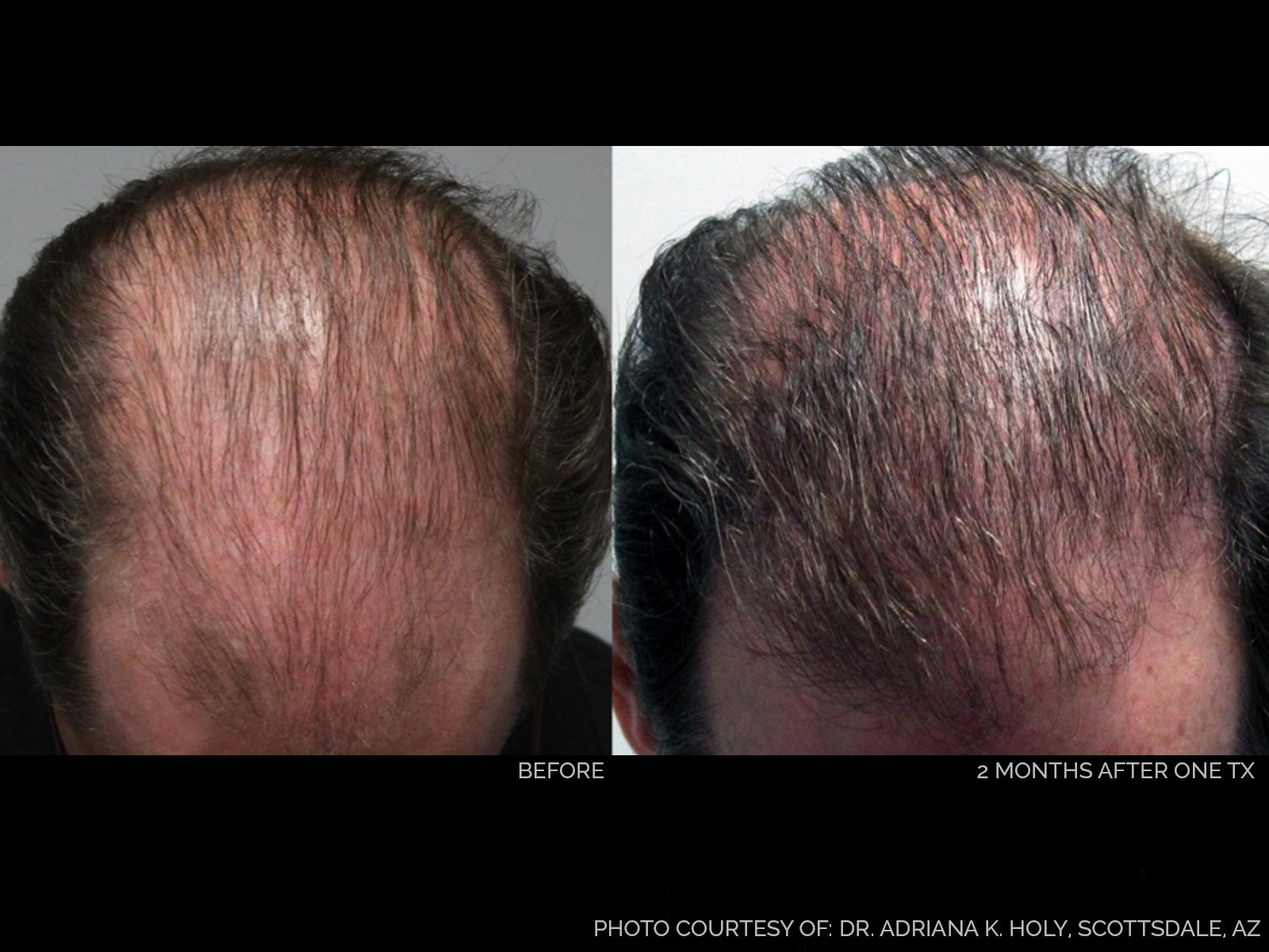 hair-rejuvenation-before-after