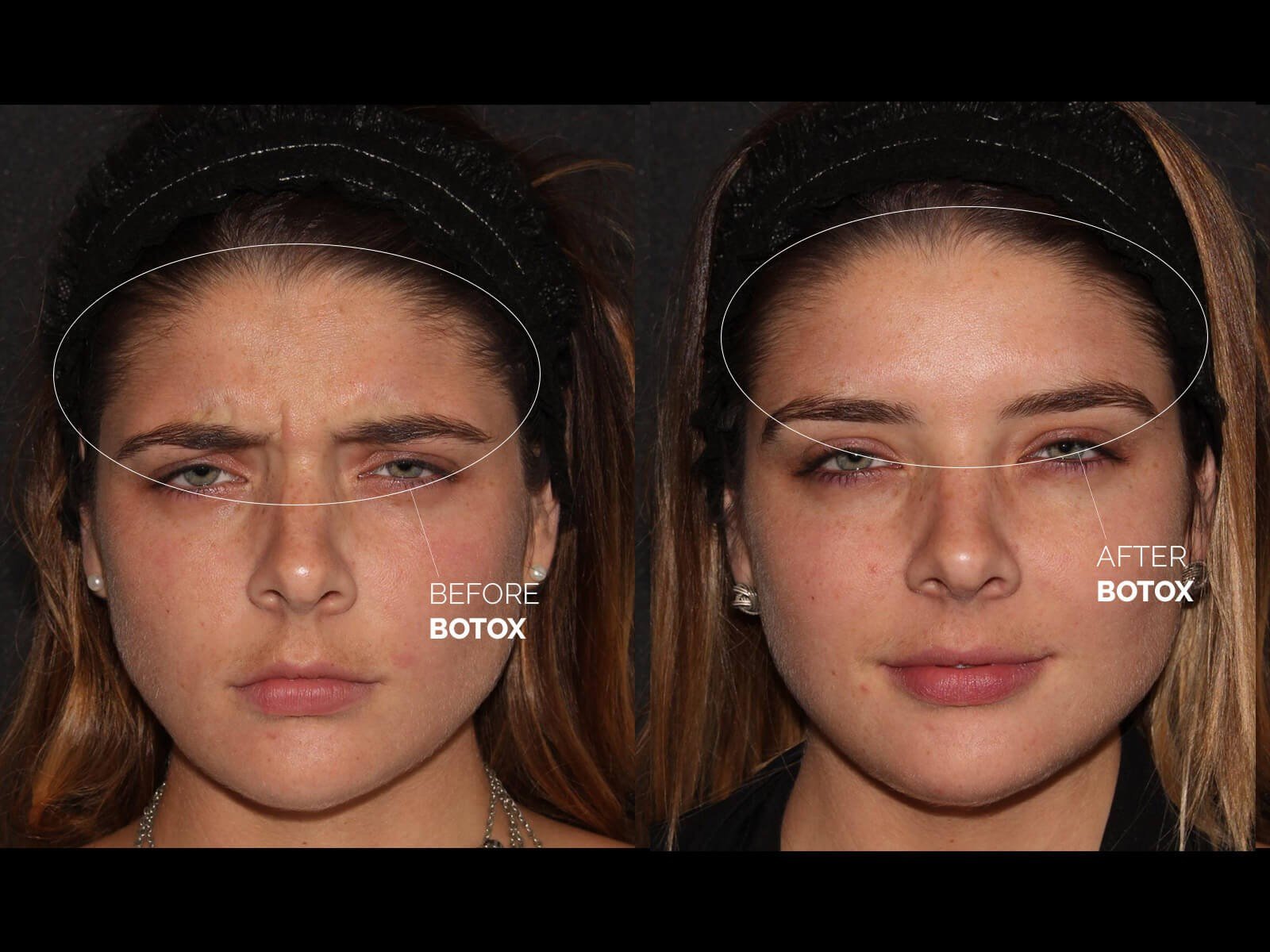 botox-before-after