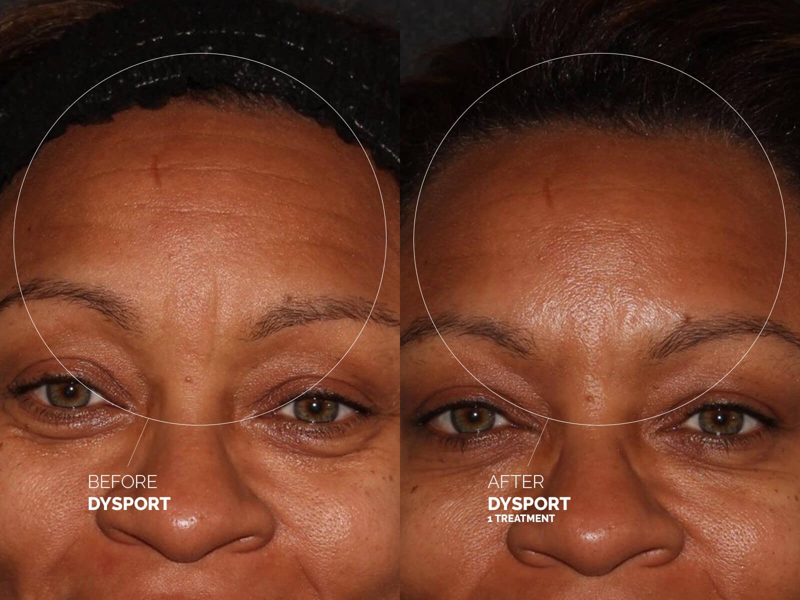 dysport-forehead-before-after
