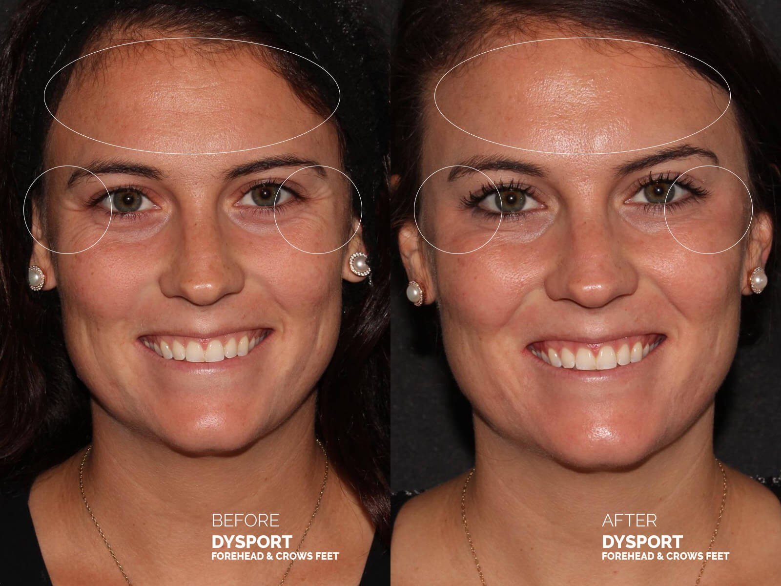 dysport-forehead-crows-feet-before-after