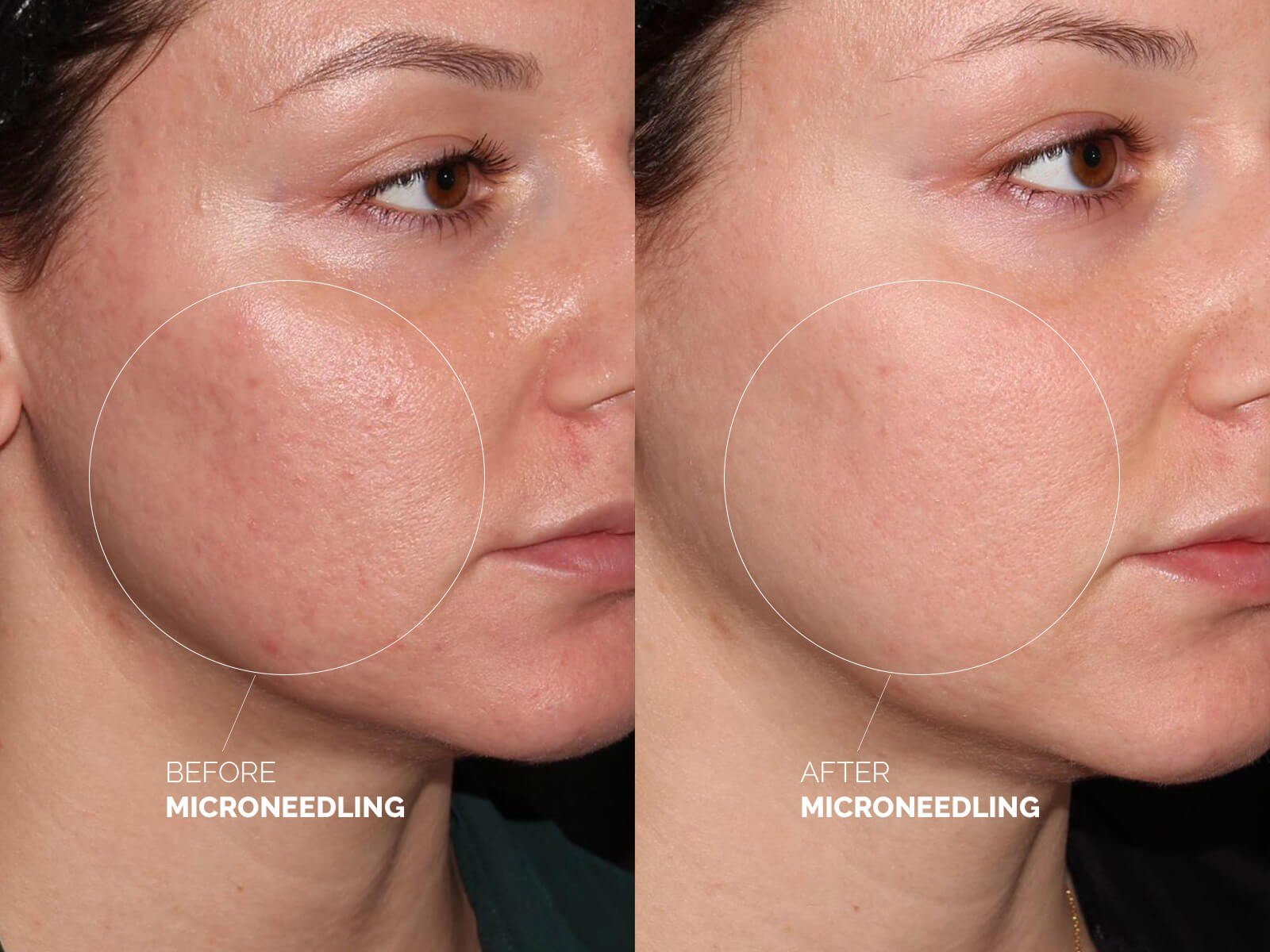 microneedling-before-after-2.