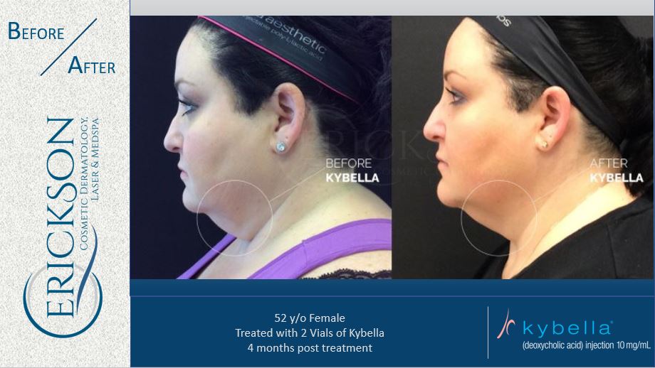 MBR_kybella watermarked