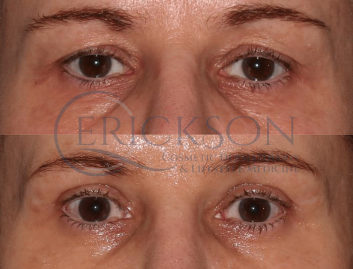 blepharoplasty patient before and after photograph