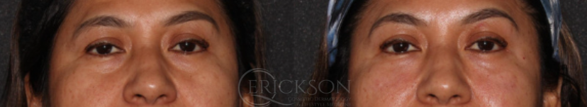 Dermal Fillers Before and After Photo by Dr. Erickson in Chicago, IL