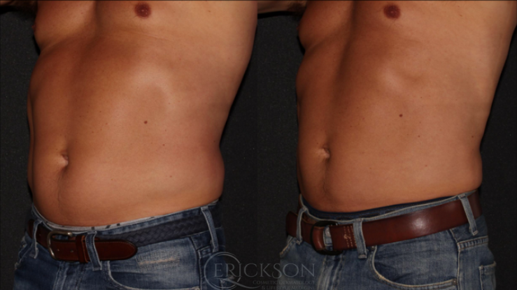 CoolSculpting For Men Before and After Photo by Dr. Erickson in Chicago, IL