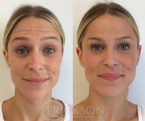 Botox Before and After Photo by Dr. Erickson in Chicago, IL