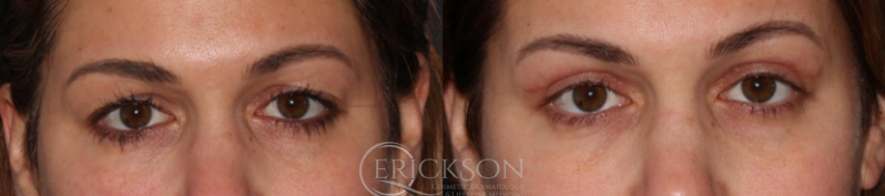 Blepharoplasty Before and After Photo by Dr. Erickson in Chicago, IL