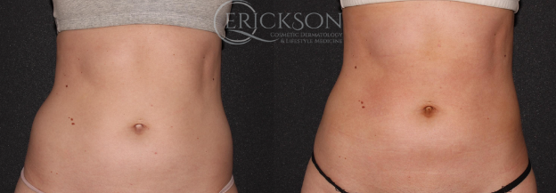 CoolSculpting Before and After Photo by Dr. Erickson in Chicago, IL