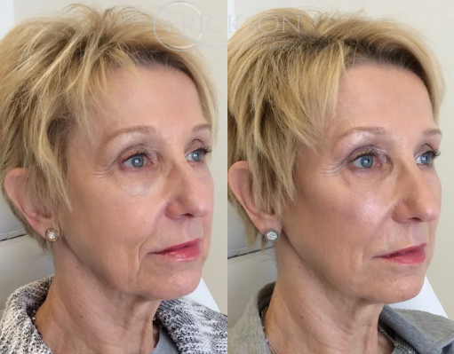 Dermal Fillers Before and After Photo by Dr. Erickson in Chicago, IL