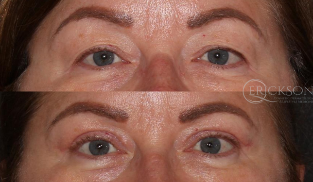 Blepharoplasty Before and After Photo by Dr. Erickson in Chicago, IL