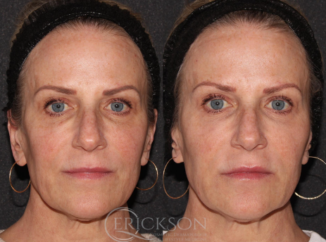 Dermal Fillers Before and After Photo by Dr. Erickson in Chicago, IL