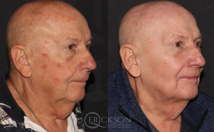 Profrac before + after results