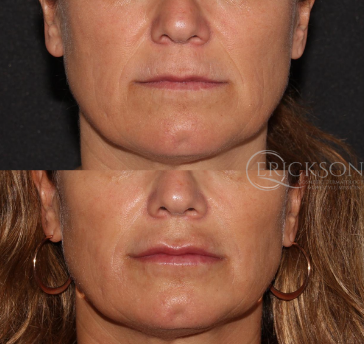 Dermal Fillers Before and After Photo by Dr. Erickson in Chicago, IL